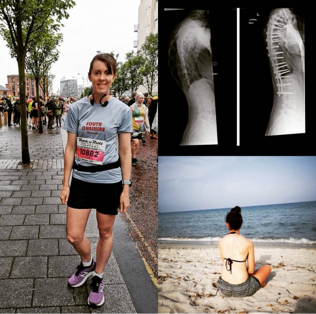 Louise's Scoliosis Journey Louises scoliosis journey.