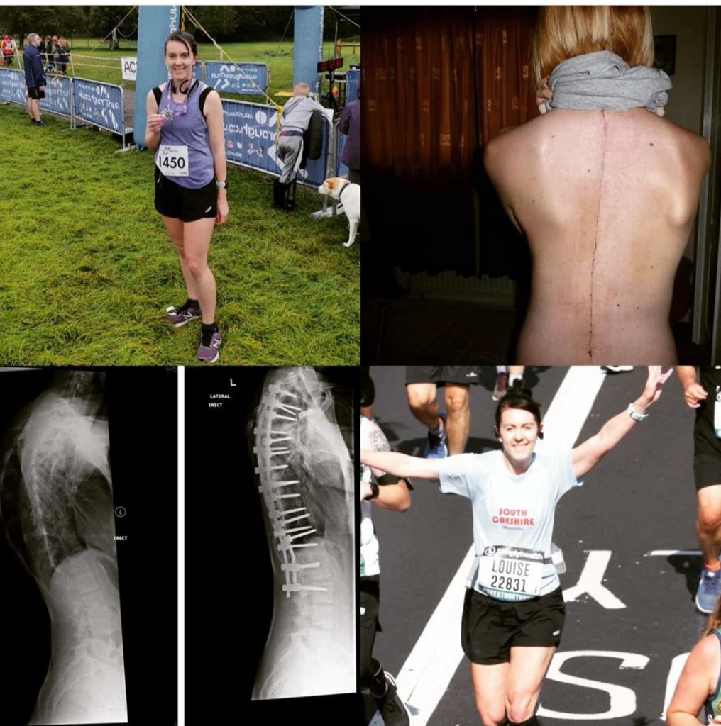 Scoliosis and Me Scoliosis and me.